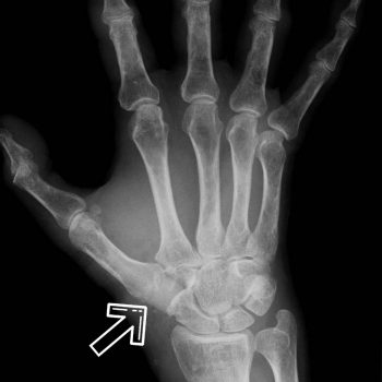 Röntgenaufnahme Arthrose Daumensattelgelenk nach Knorpelimplantation Orthopädie Rosenheim