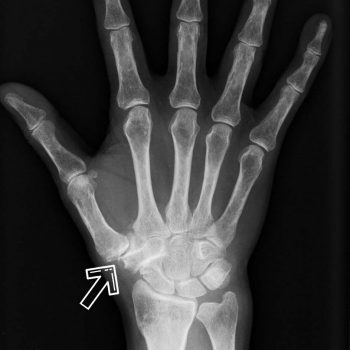 Röntgenaufnahme Arthrose Daumensattelgelenk rechts Orthopädie Rosenheim